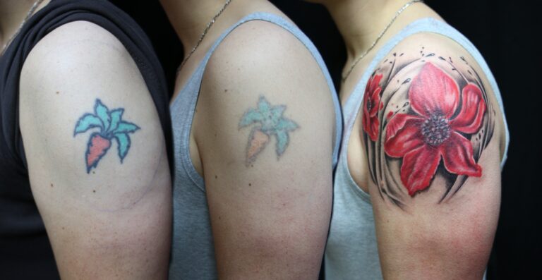 tattoo removal gurgaon